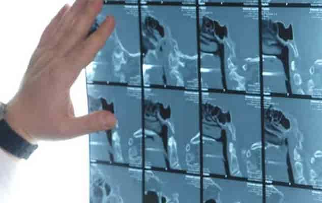 Endoskopische Nasennebenhöhlenchirurgie