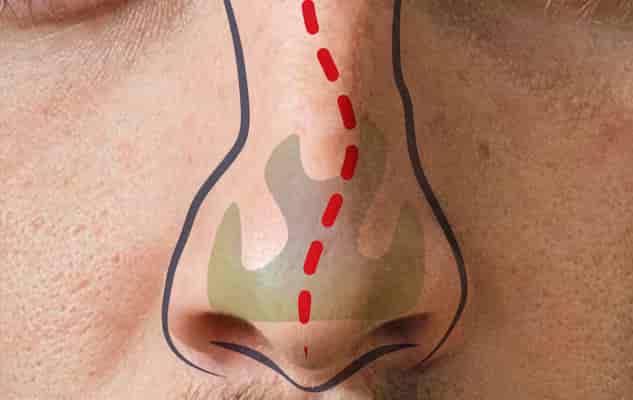 Septumplastik, Septumkorrektur, Nasenscheidewandkorrektur