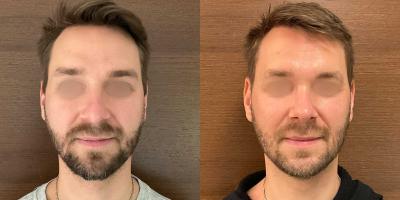 Nasenoperation Langnase mit Überlänge