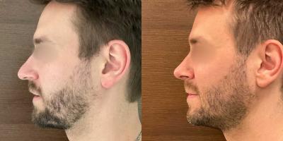 Nasenoperation Langnase mit Überlänge