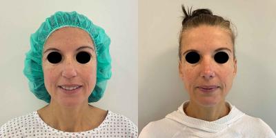 Nasenkorrektur Höcker-Breitnase