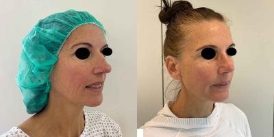 Nasenkorrektur Höcker-Breitnase