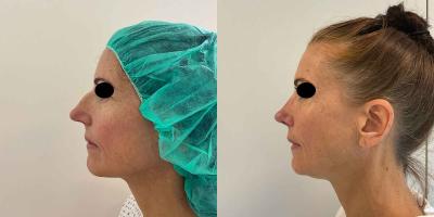 Nasenkorrektur Höcker-Breitnase